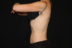 CoolSculpting® Before and After Pictures Glastonbury, CT