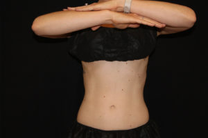 CoolSculpting® Before and After Pictures Glastonbury, CT