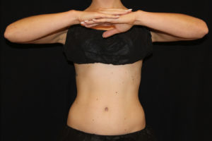 CoolSculpting® Before and After Pictures Glastonbury, CT