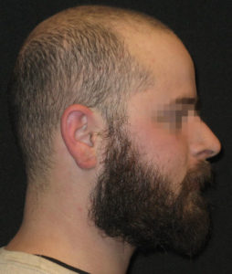 Earlobe Repair Before and After Pictures Glastonbury, CT