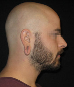 Earlobe Repair Before and After Pictures Glastonbury, CT