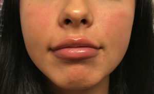 Lip Augmentation Before and After Pictures Glastonbury, CT