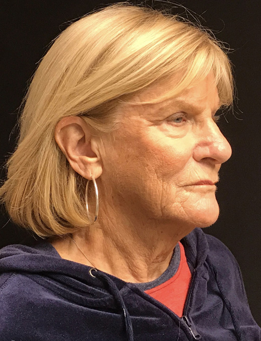 Liquid Facelift Before and After Pictures Glastonbury, CT
