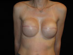 Breast Reconstruction Before and After Pictures Glastonbury, CT