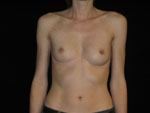 Breast Reconstruction Before and After Pictures Glastonbury, CT