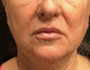 Lip Augmentation Before and After Pictures Glastonbury, CT