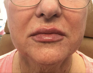 Lip Augmentation Before and After Pictures Glastonbury, CT