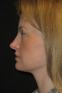 Rhinoplasty Before and After Pictures Glastonbury, CT