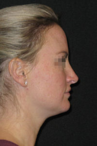Rhinoplasty Before and After Pictures Glastonbury, CT