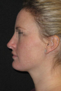 Rhinoplasty Before and After Pictures Glastonbury, CT