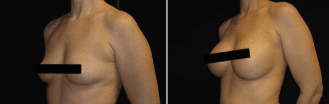 miraDry® in Glastonbury, CT