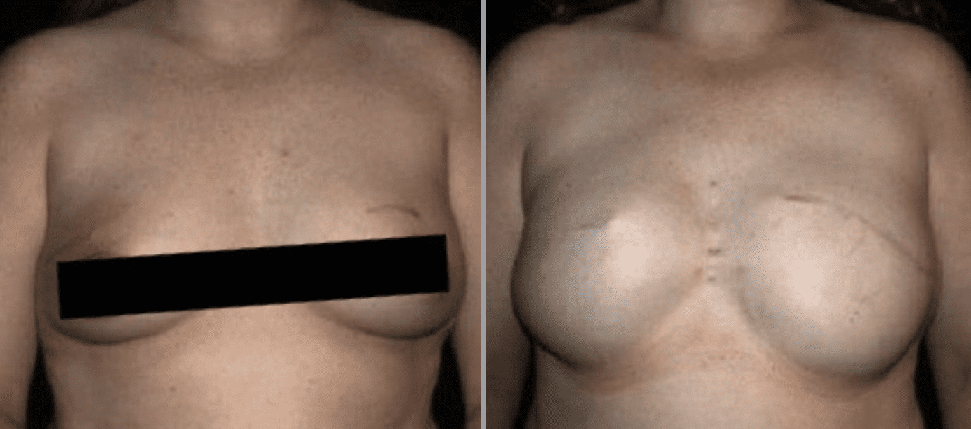 Breast Reconstruction in Glastonbury, CT