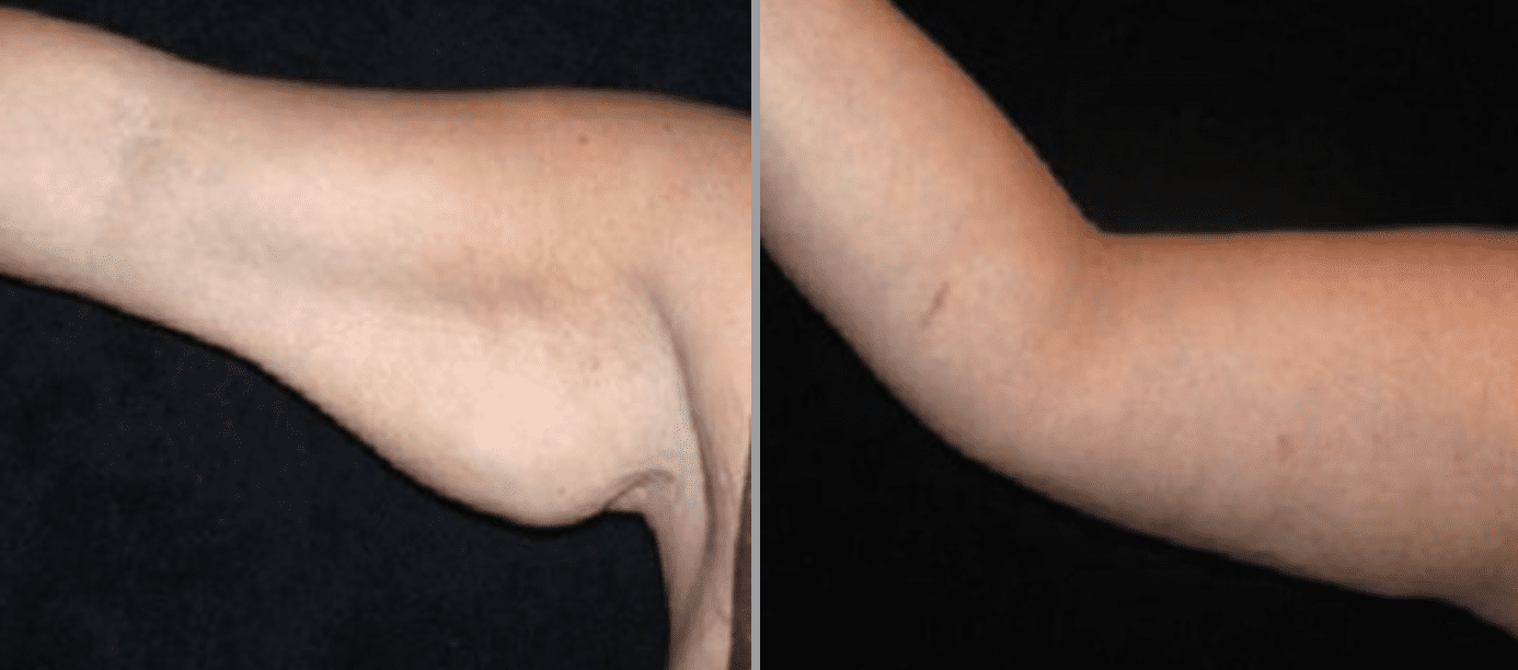 Arm Lift in Glastonbury, CT