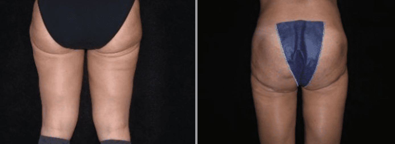 Thigh Lift in Glastonbury, CT