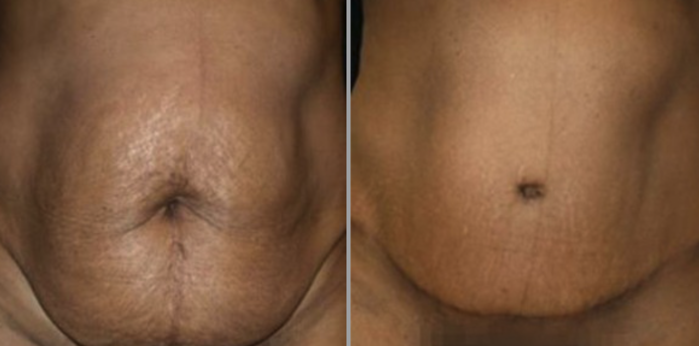 miraDry® in Glastonbury, CT