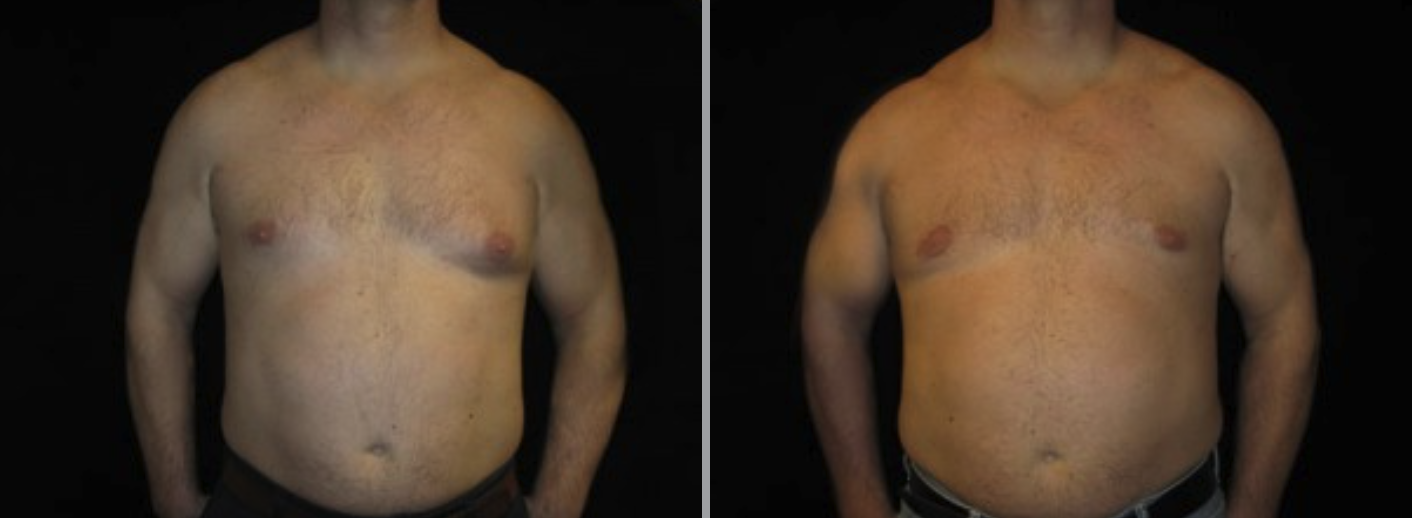 miraDry® in Glastonbury, CT