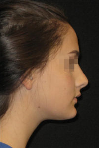 Rhinoplasty Before and After Pictures Glastonbury, CT