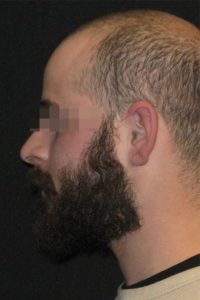 Earlobe Repair Before and After Pictures Glastonbury, CT