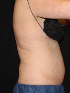 CoolSculpting® Before and After Pictures Glastonbury, CT