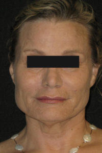 Laser-Ablative Before and After Pictures Glastonbury, CT