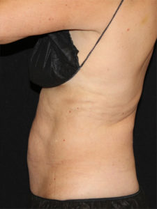 CoolSculpting® Before and After Pictures Glastonbury, CT