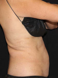 CoolSculpting® Before and After Pictures Glastonbury, CT
