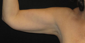 CoolSculpting® Before and After Pictures Glastonbury, CT
