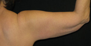 CoolSculpting® Before and After Pictures Glastonbury, CT