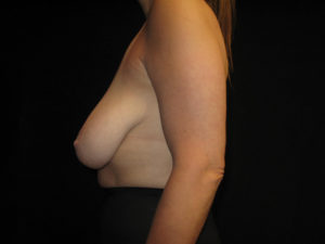 Inverted Nipples Before and After Pictures Glastonbury, CT