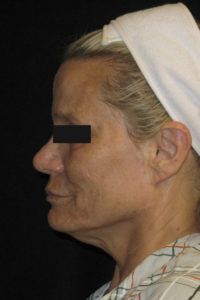 Laser-Ablative Before and After Pictures Glastonbury, CT