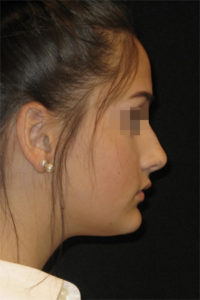 Rhinoplasty Before and After Pictures Glastonbury, CT