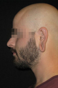 Earlobe Repair Before and After Pictures Glastonbury, CT