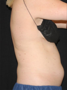 CoolSculpting® Before and After Pictures Glastonbury, CT