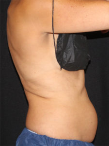 CoolSculpting® Before and After Pictures Glastonbury, CT