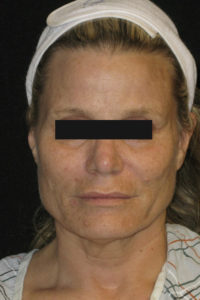 Laser-Ablative Before and After Pictures Glastonbury, CT