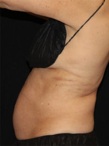 CoolSculpting® Before and After Pictures Glastonbury, CT