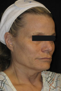 Laser-Ablative Before and After Pictures Glastonbury, CT