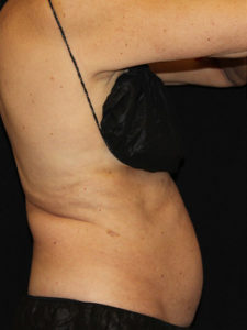 CoolSculpting® Before and After Pictures Glastonbury, CT
