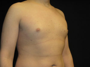 Gynecomastia Before and After Pictures Glastonbury, CT