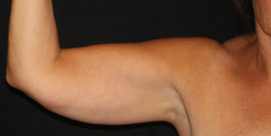 CoolSculpting® Before and After Pictures Glastonbury, CT