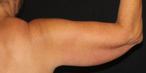CoolSculpting® Before and After Pictures Glastonbury, CT