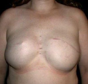 Breast Reconstruction Before and After Pictures Glastonbury, CT