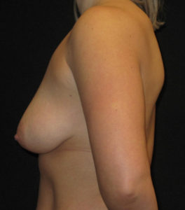 Breast Augmentation Before and After Pictures Glastonbury, CT