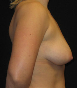 Breast Augmentation Before and After Pictures Glastonbury, CT