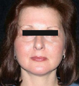 Facelift Before and After Pictures Glastonbury, CT