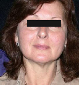 Facelift Before and After Pictures Glastonbury, CT
