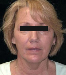 Liposuction Before and After Pictures Glastonbury, CT