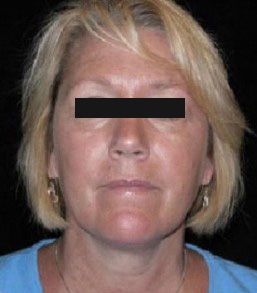 Liposuction Before and After Pictures Glastonbury, CT