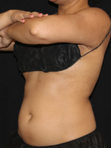CoolSculpting® Before and After Pictures Glastonbury, CT