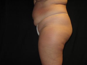 Liposuction Before and After Pictures Glastonbury, CT
